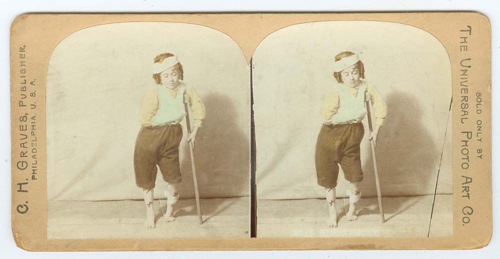 G0539~ Crippled Boy With Crutch – One Arm - Head & Leg Bandages Stereoview