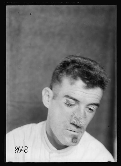 Photo:New York City Bellevue Hospital Gas Burns Skin Disease Patient 1918