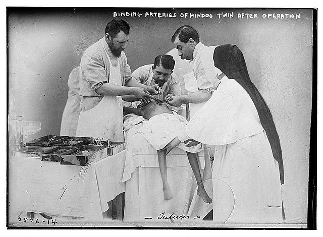 Photo:Paris France Dr Eugene-Louis Doyen Conjoined Twins Surgery 1902