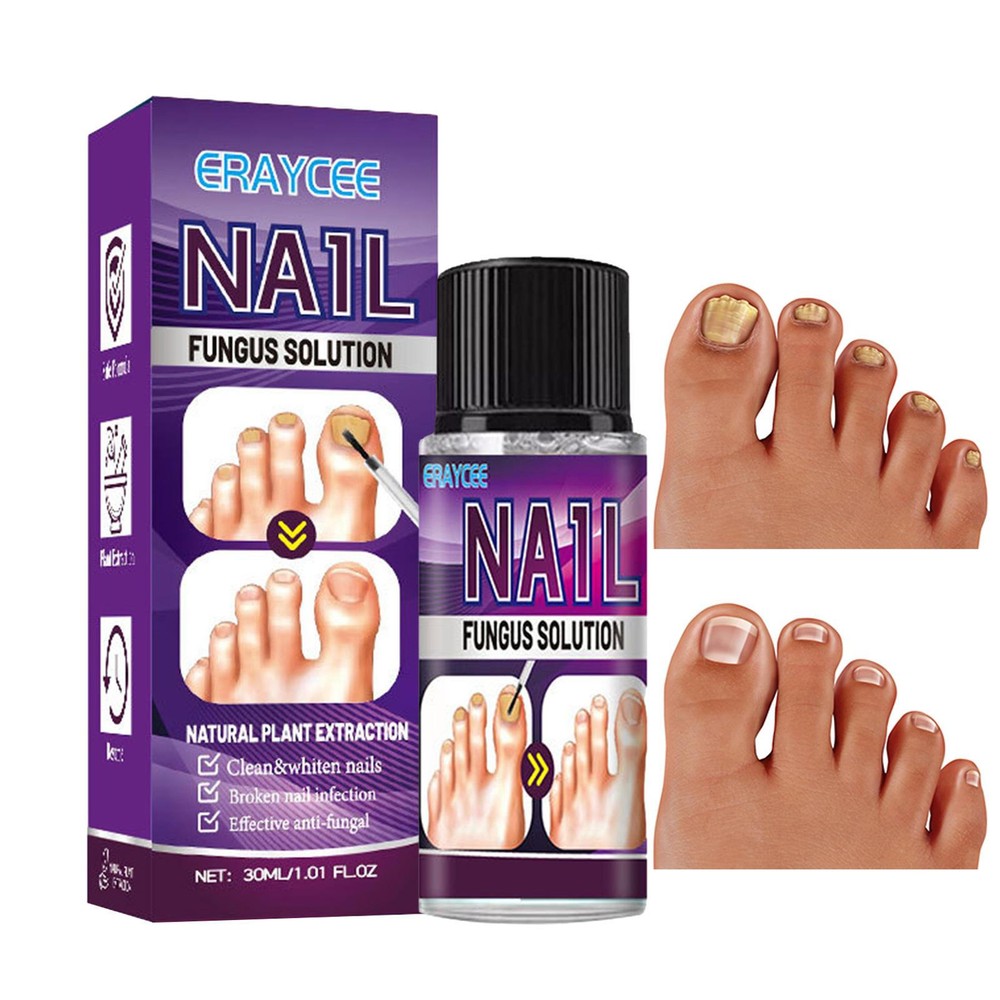 30ml Nail Fungal Treatment Antibacterial Kills Toe & Finger Nail Fungus Solution