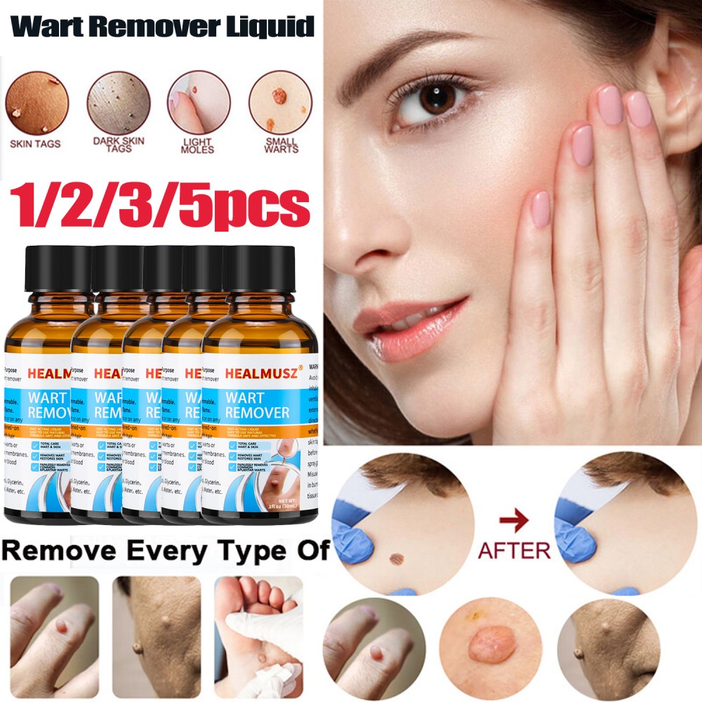 1-5PC Wart Remover Liquid Skin Tag Mole Remover Eliminate Feet Corn Wart Remove