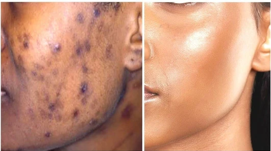 Ayurvedic Pigmed Cream 30gm Acne Scars Dark Spots Pimple Marks Anti Blemish skin